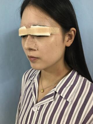 南京华美曹海峰眼手术案例