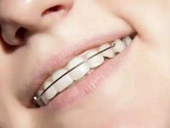 牙齿畸形怎么矫正？正畸牙要注意什么？