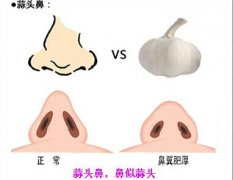 蒜头鼻的整形改善方法有哪些？
